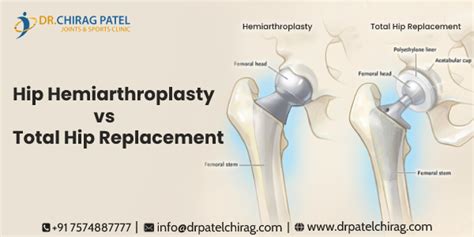 total hip arthroscopy chanel boyer|total hip hemiarthroplasty technique.